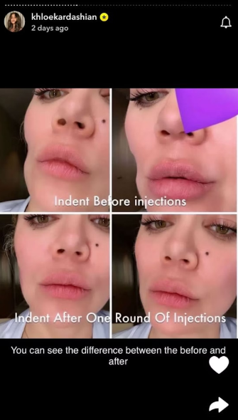 Khloe Kardashian Lip Fillers Snapchat Story
